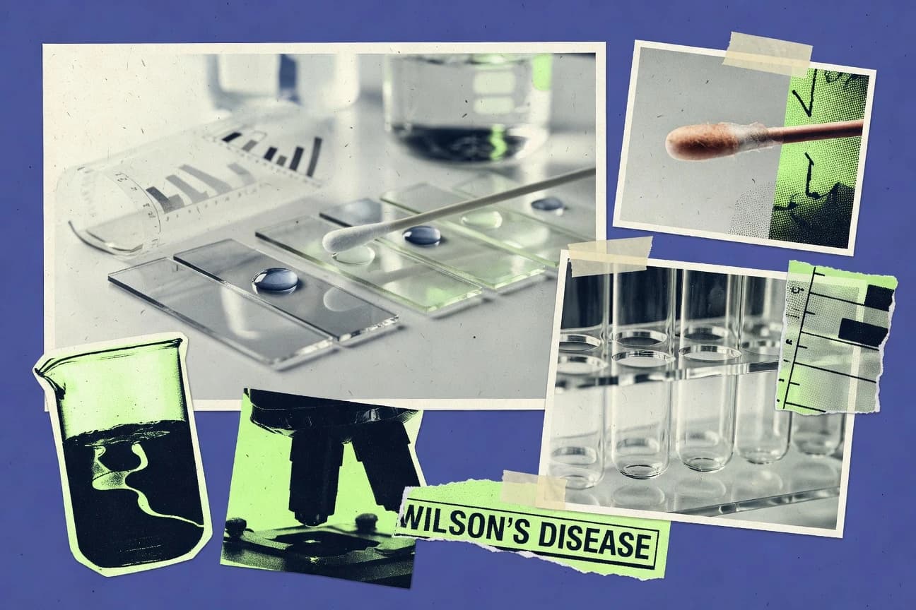 Wilsons Disease Statistics