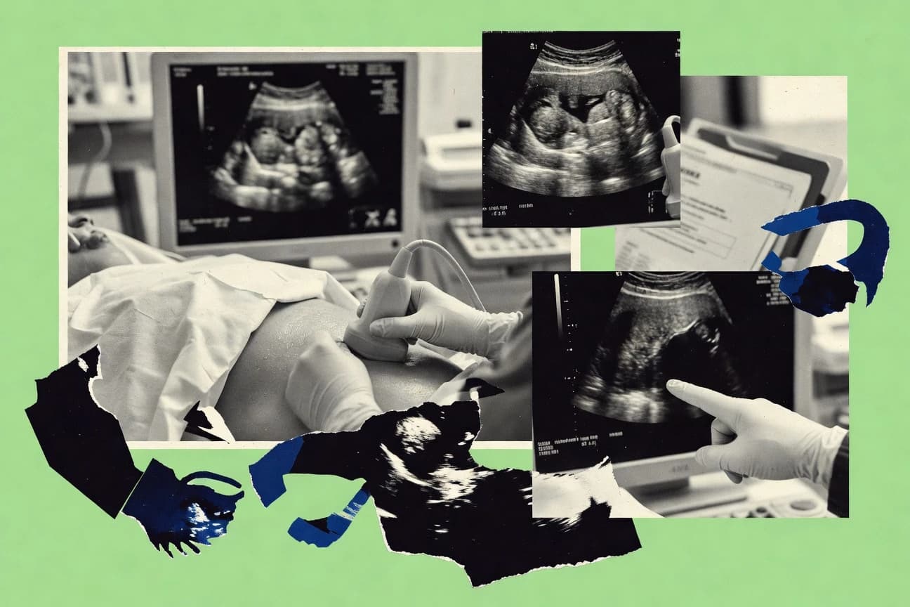 Placenta Previa Statistics