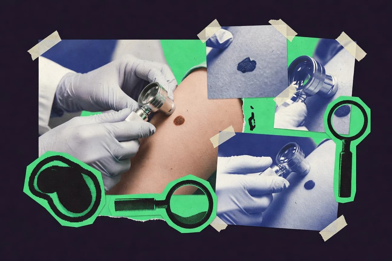 Melanoma Skin Cancer Statistics