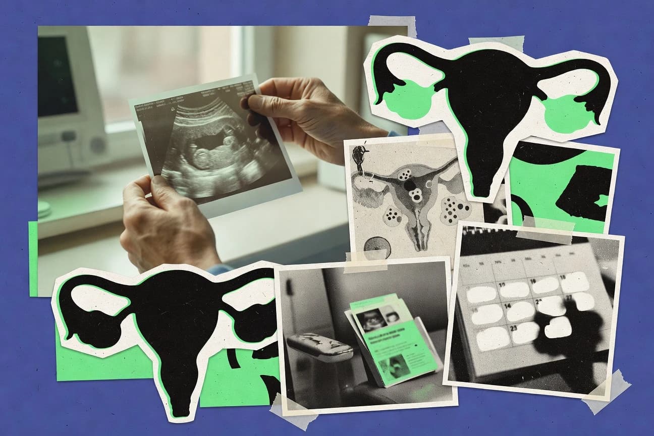 Pcos And Fertility Statistics