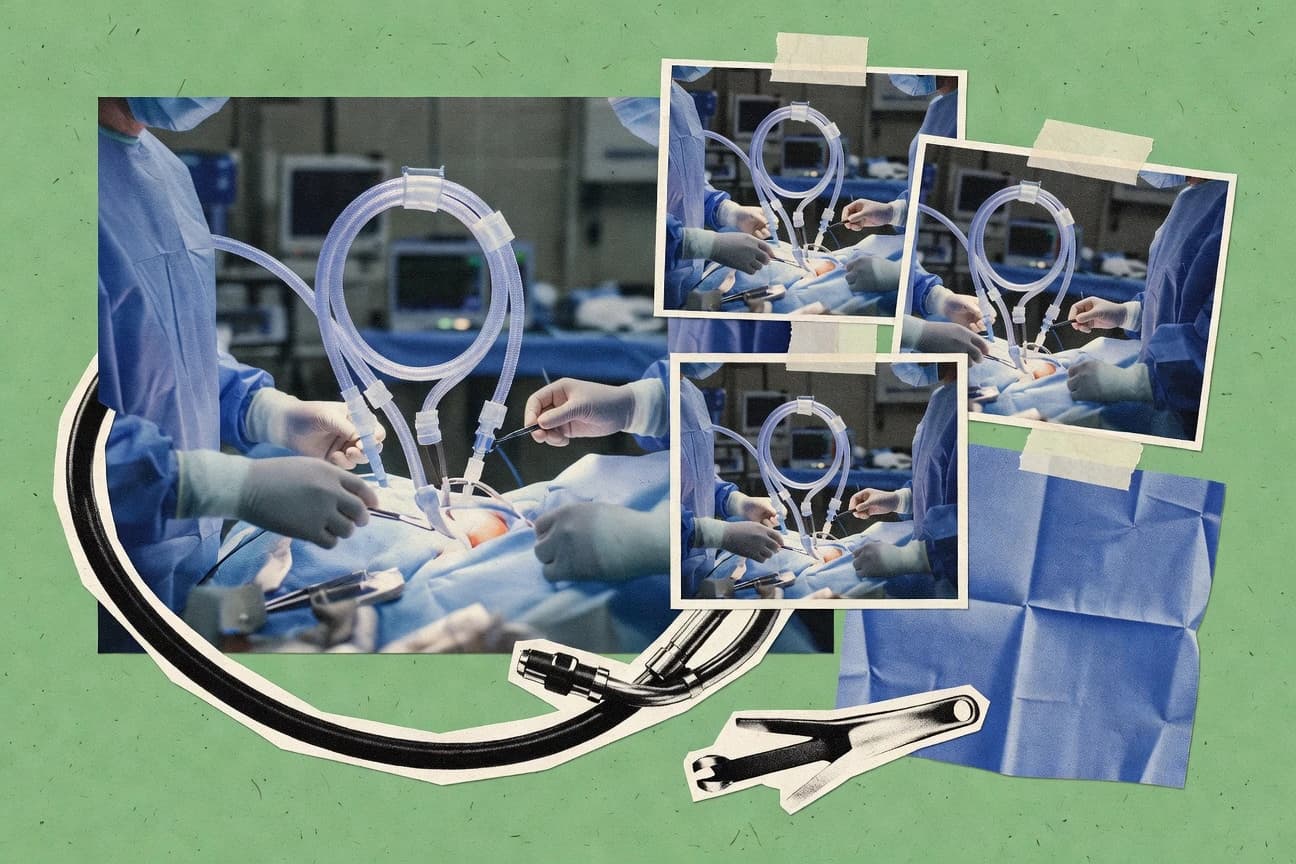 Open Heart Surgery Statistics