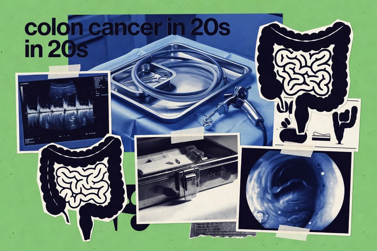 Colon Cancer In 20S Statistics