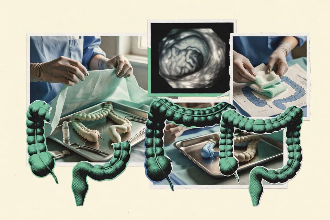 Colon Cancer Statistics