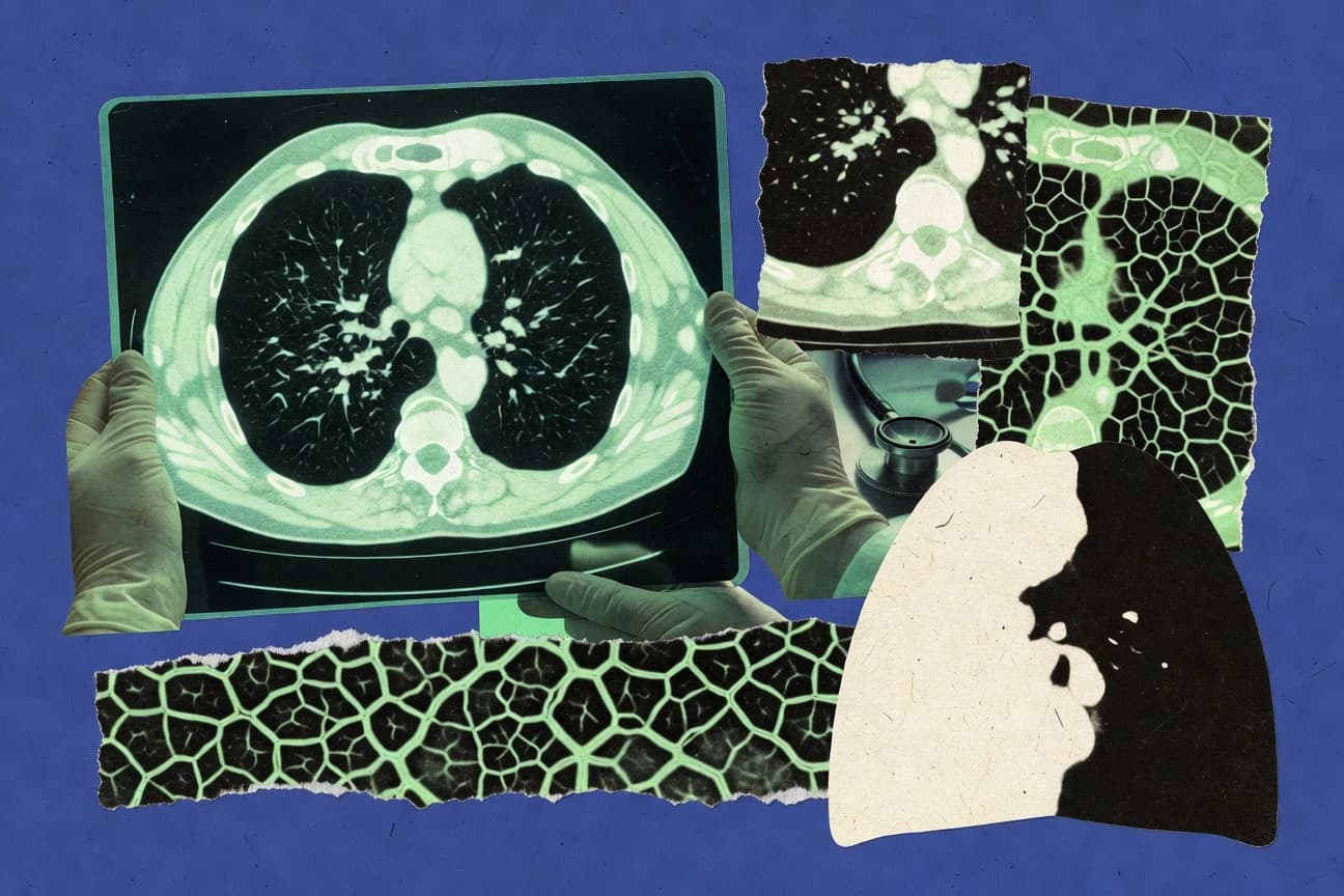 Pulmonary Fibrosis Statistics