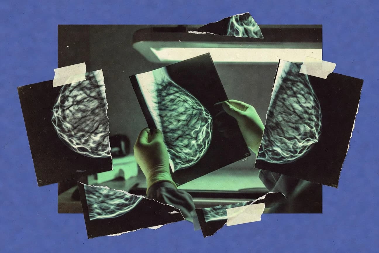 Mammogram Statistics