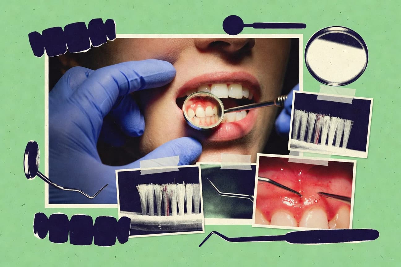 Periodontal Disease Statistics