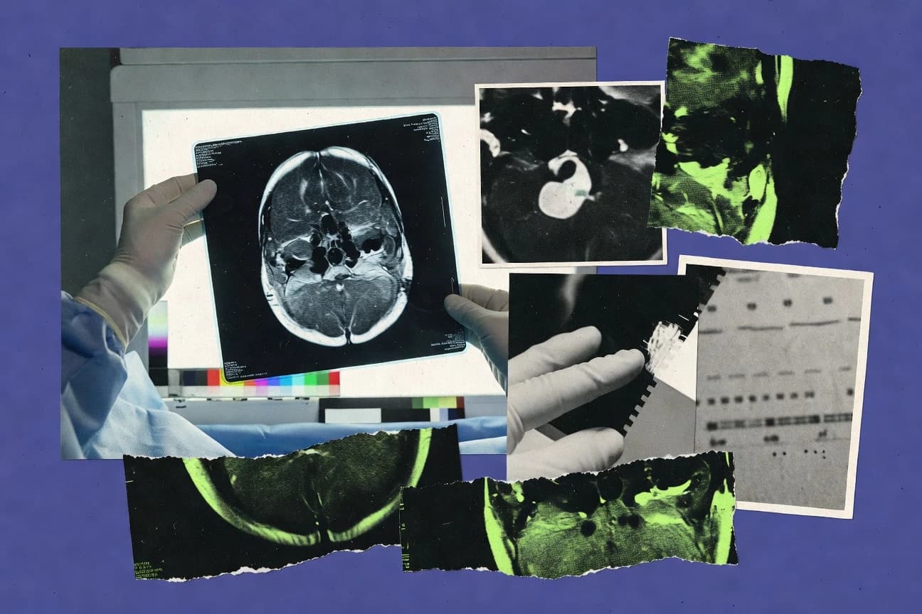 Brain Tumor Statistics