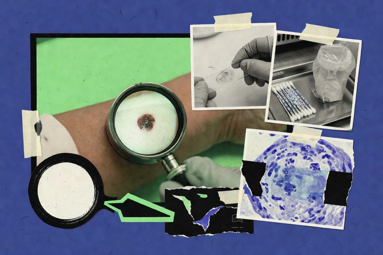 Melanoma Cancer Statistics