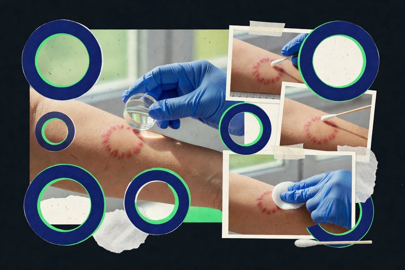 Ringworm Statistics