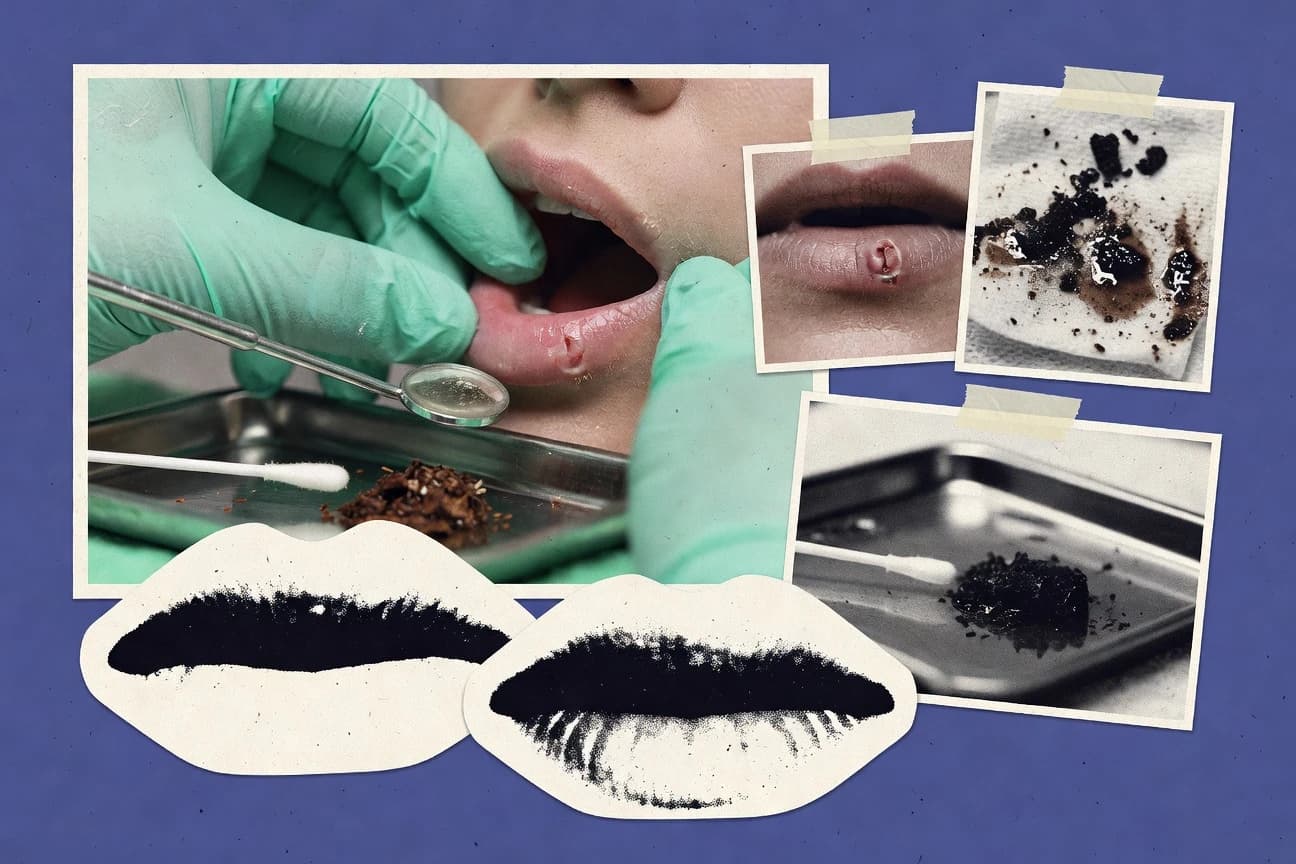 Oral Cancer From Dipping Statistics