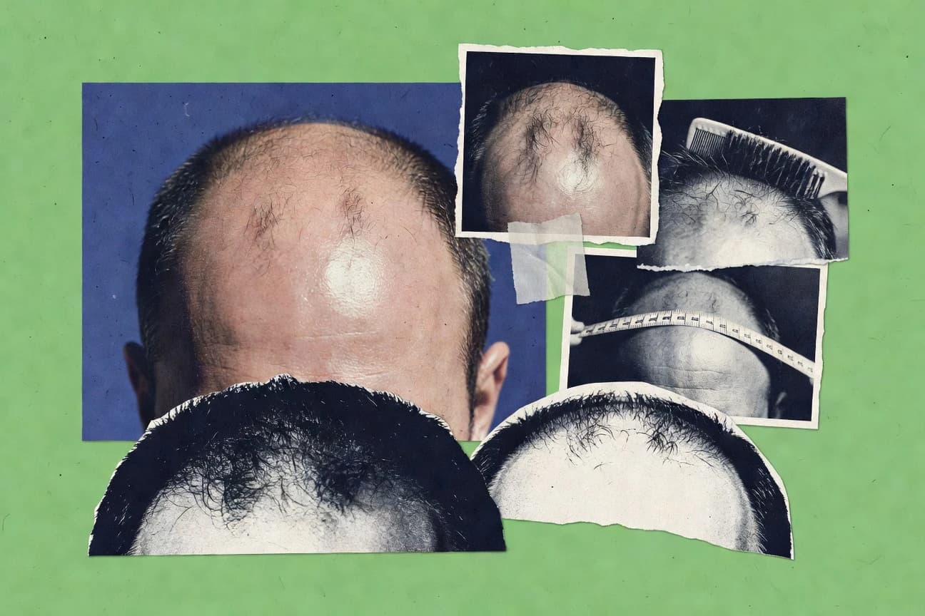Baldness Statistics