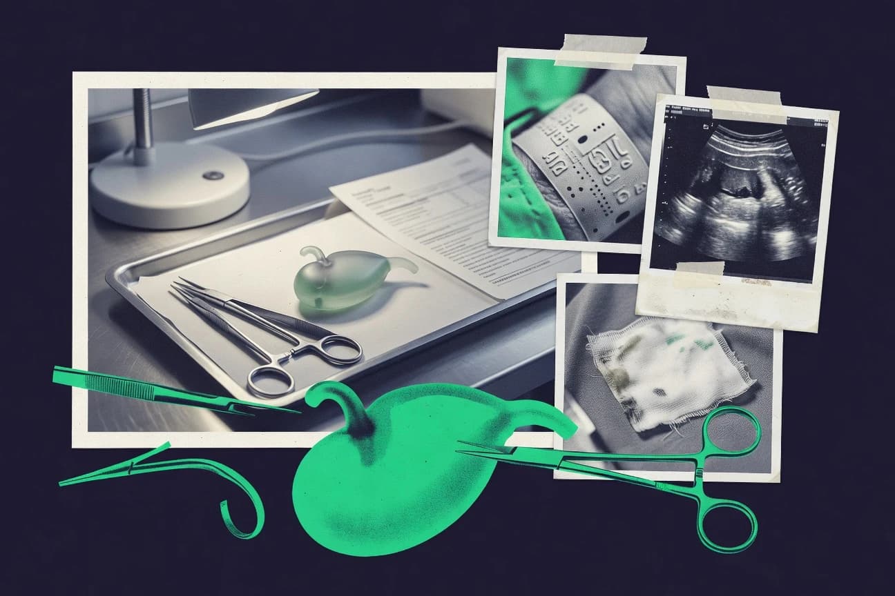 Gallbladder Removal Age Statistics